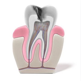 Root Canals