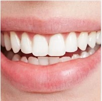 Tooth Whiting (30 mins off bleaching)